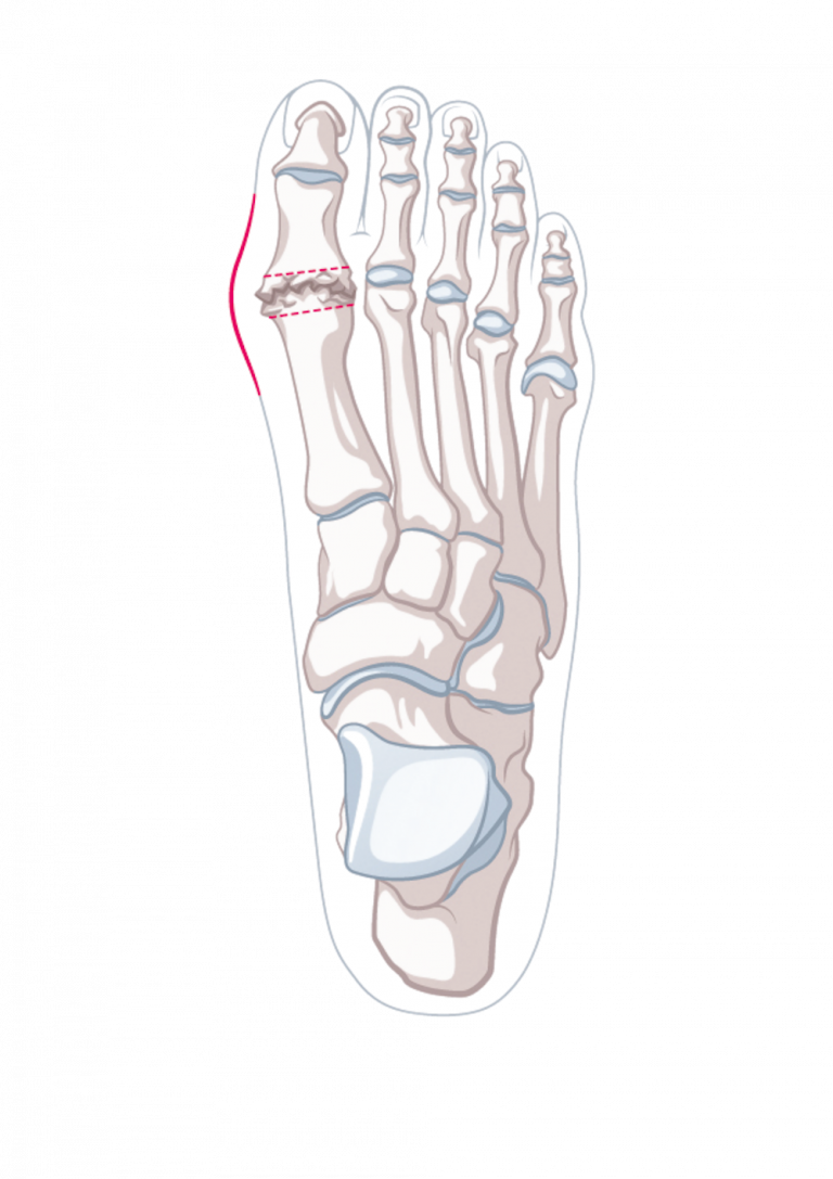 Hallux Rigidus, Fuss | Gelenkzentrum Zürich, Bethanien