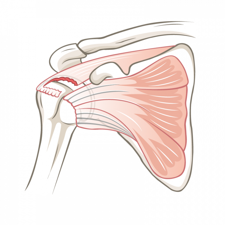 Riss Rotatorenmanschetten, Schulter | Gelenkzentrum Zürich